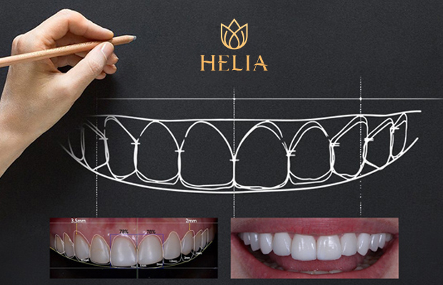 Kích thước răng khi bọc răng sứ cần ôm trọn vào thân răng, mặt nhai - rìa cắn và cả viền nướu.