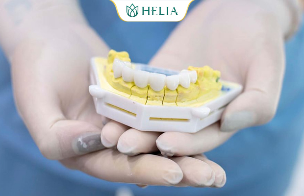 Bọc răng sứ - Giải pháp khắc phục răng không đều một cách nhanh chóng