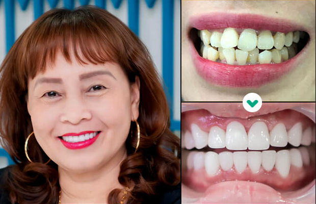 Khách hàng sử dụng dịch vụ bọc răng sứ Pico Zolid Đức khắc phục tình trạng răng không đều