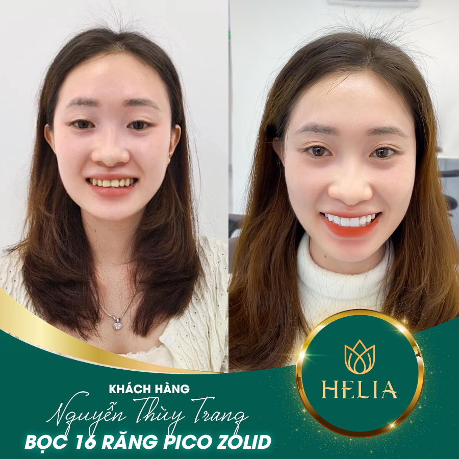 KH. THÙY TRANG - Bọc 16 răng sứ Pico Zolid tại HELIA
