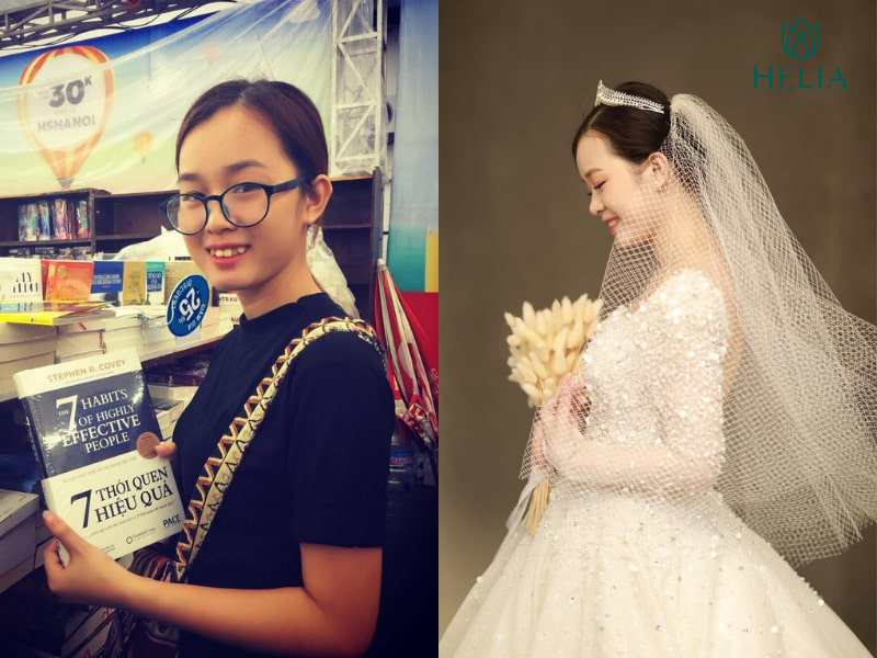 Cấu trúc niềng răng mắc cài gồm 3 phần