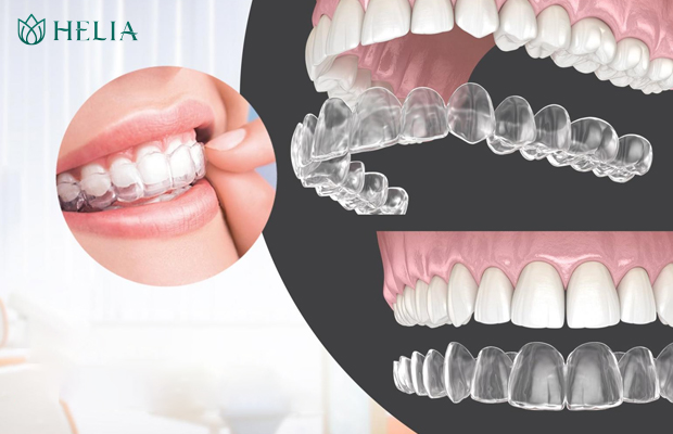 Phương pháp niềng răng trong suốt đem lại tính thẩm mỹ vươt trội