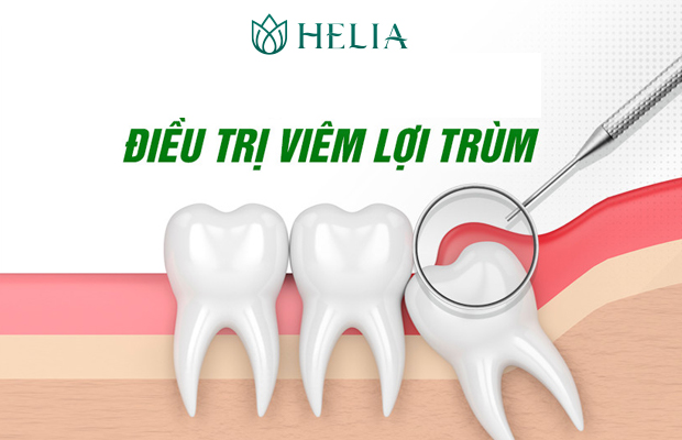 Những lưu ý khi cắt lợi trùm