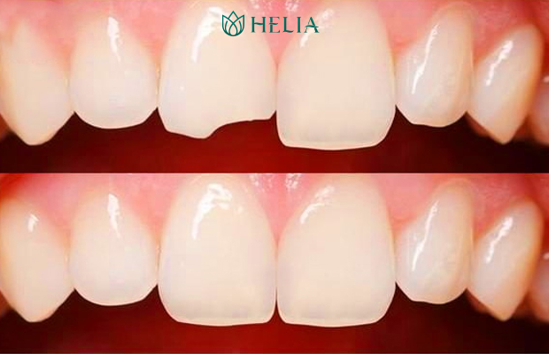 Răng vỡ mẻ cũng có thể sử dụng phương pháp trám răng thẩm mỹ