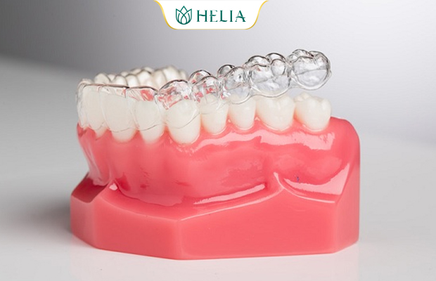 Ưu điểm khi thực hiện niềng răng trong suốt