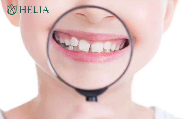 Những trường hợp không nên nhổ răng sữa cho trẻ tại nhà