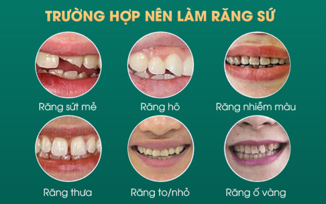 Bọc răng sứ - Bảo vệ răng bị chết tuỷ