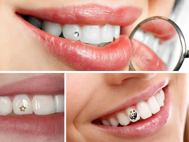 Đính đá răng - Đẹp mọi góc nhìn cho nụ cười hoàn hảo