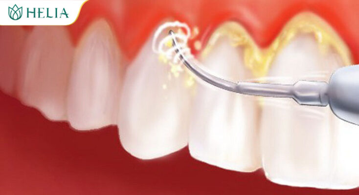 Lấy cao răng thường xuyên cho răng miệng khỏe mạnh