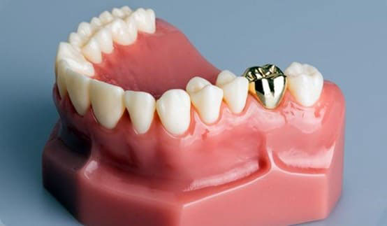Răng sứ kim loại quý