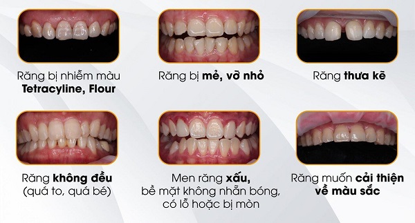 Trường hợp nên dán sứ Veneer
